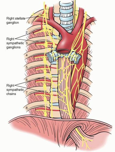سمپاتکتومی
