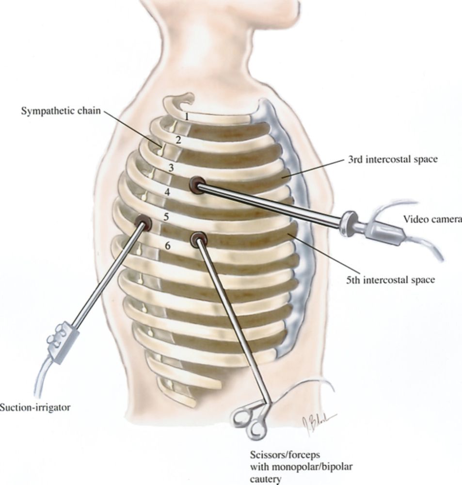 سمپاتکتومی