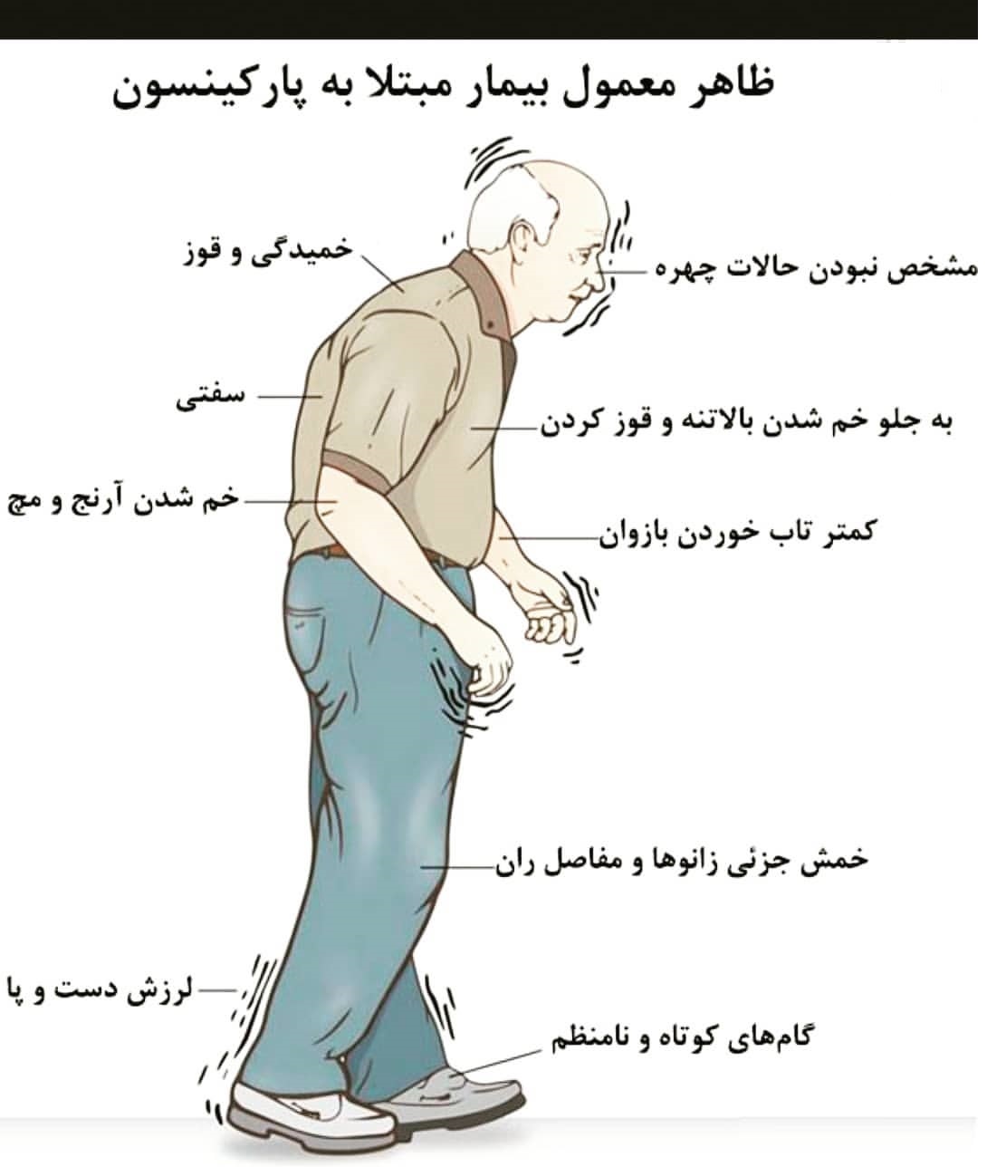 پارکینسون