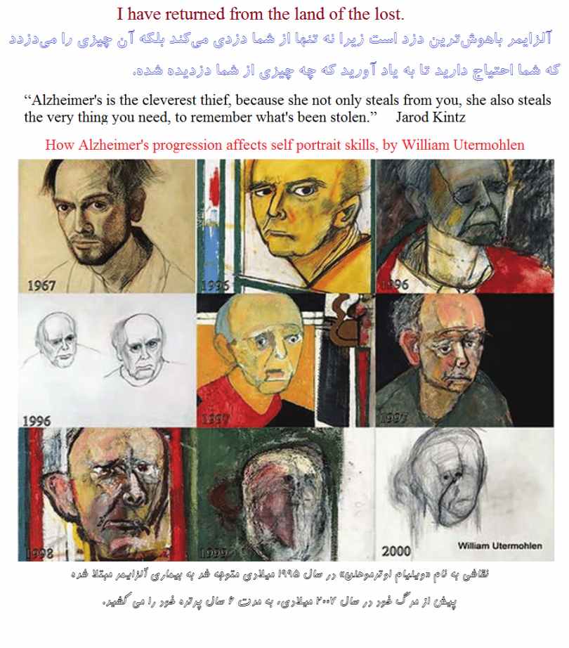 آلزایمر