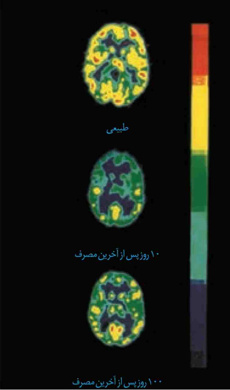 تصویرها مصرف گلوکز را در مغز فرد سالم و فرد مصرف‌کننده کوکائین نشان می‌دهند.