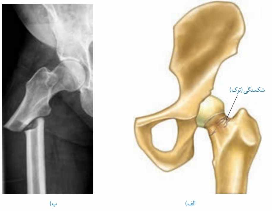شکستگی ناشی از صدمه در سر استخوان ران