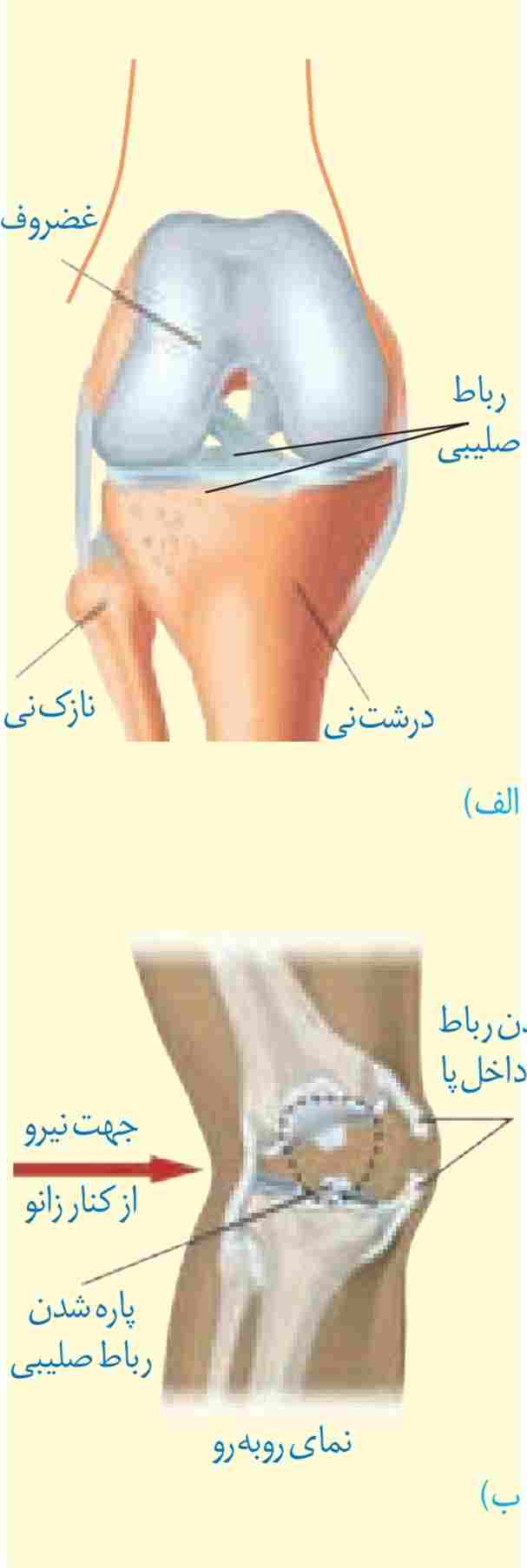 پارگی رباط صلیبی