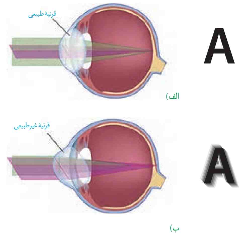 مقایسه تشکیل تصویر در  الف) چشم طبیعی ب) چشم آستیگمات