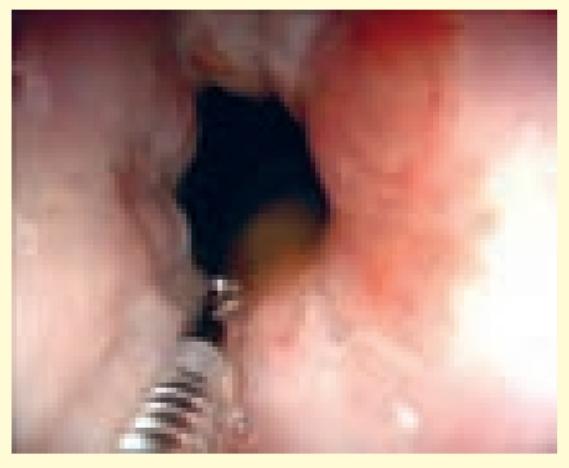 مشاهده درون لوله گوارش