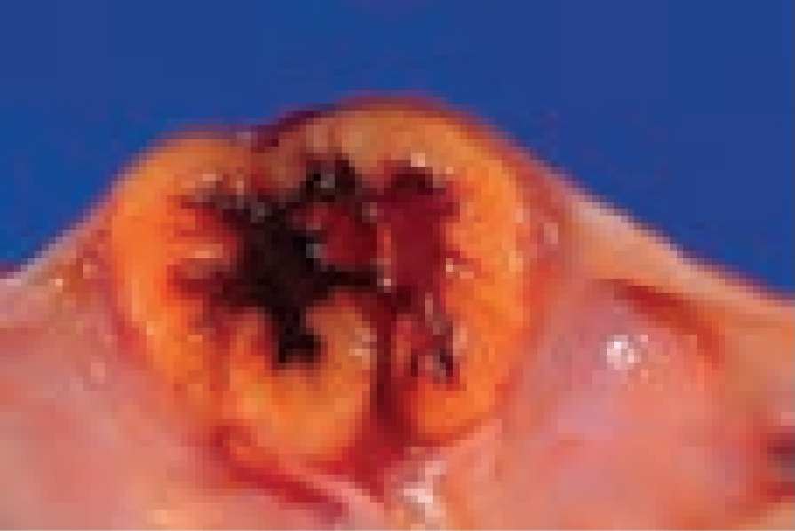 جسم زرد در تخمدان