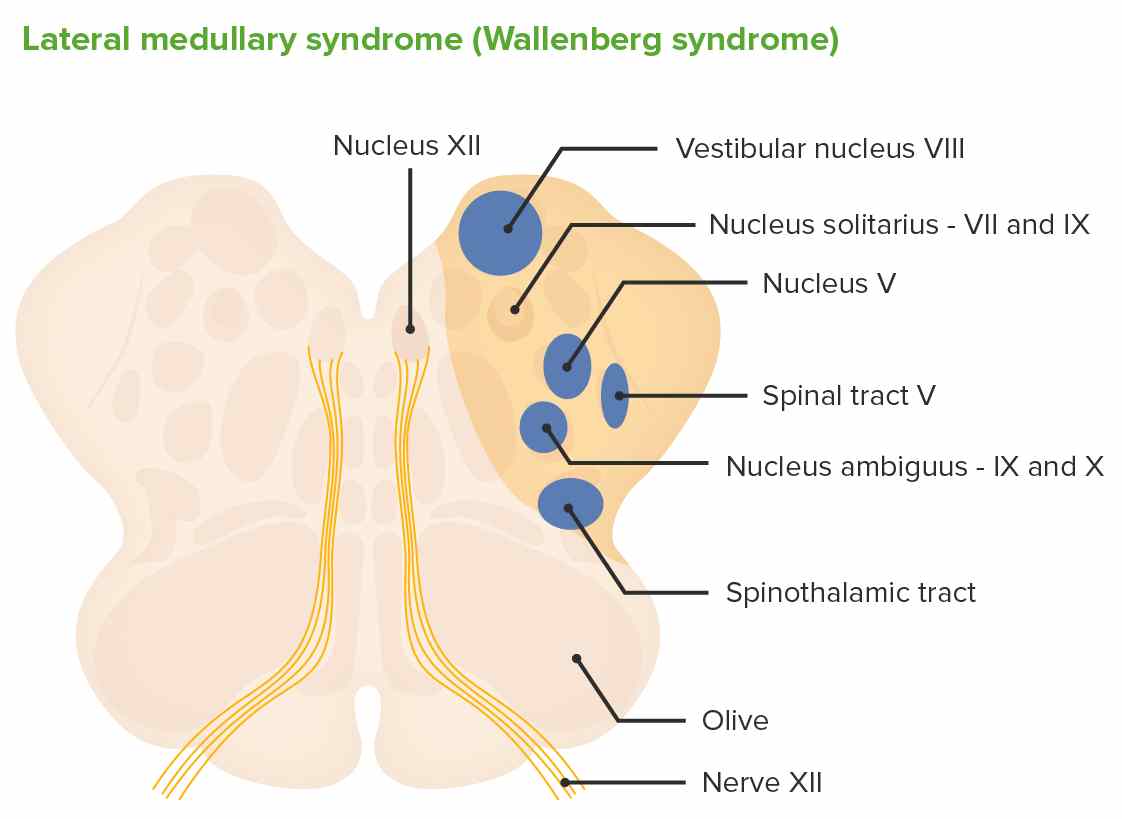 Lateral Medullary Syndrom