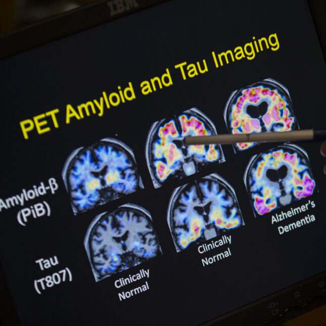 تاو آلزایمر