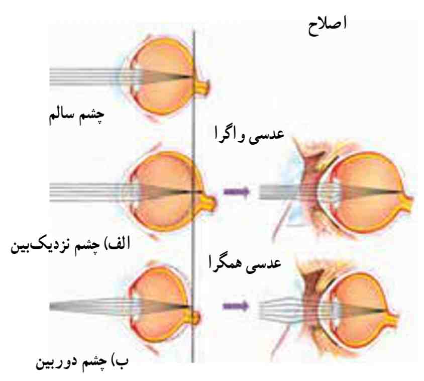 عیوب انکساری چشم و راه‌های اصلاح آن‌ها الف) نزدیک بینی و ب) دوربینی