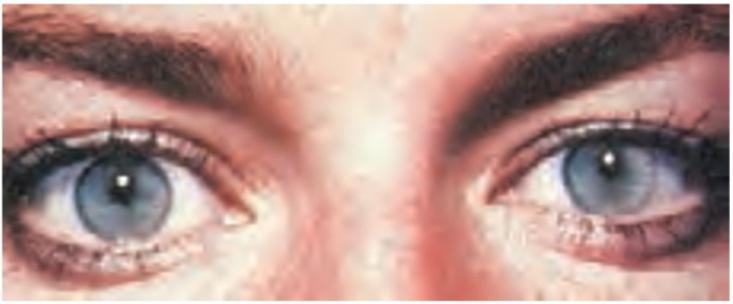 مردمک‌های تنگ ناشی از مسمومیت دارویی یا بیماری دستگاه عصبی مرکزی است