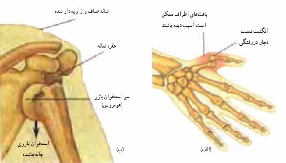 انواع دررفتگی