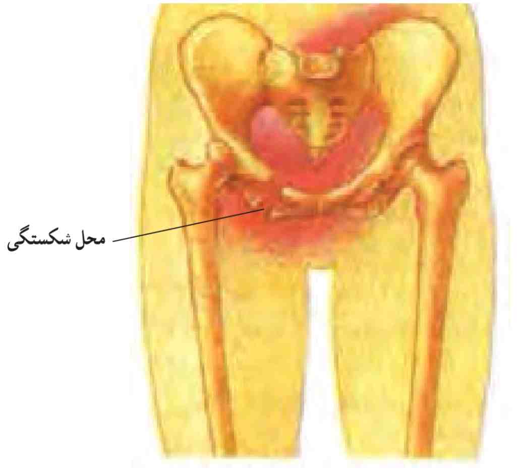 شکستگی لگن