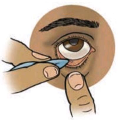 روش خارج کردن جسم از پلک پایینی چشم
