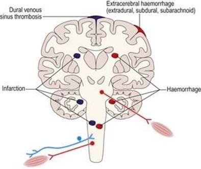 اختلالات عروقی سیستم عصبی عضلانی