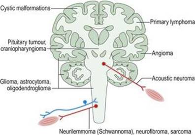 نئوپلازی سیستم عصبی عضلانی