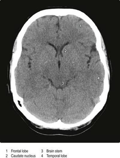 اسکن محوری کامپیوتری (CT) سر