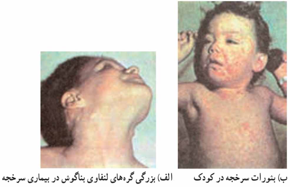 بیماران مبتلا به سرخجه