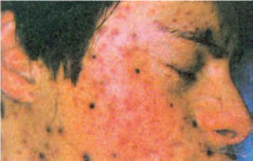 یک کودک با آبله مرغان خونریزی دهنده