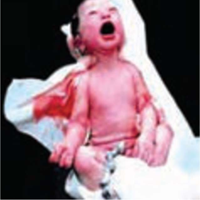 یک نوزاد مبتلا به کمبود اکسیژن که در داخل رحم مادر به آن دچار شده
