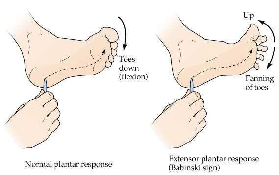 علامت بابینسکی
