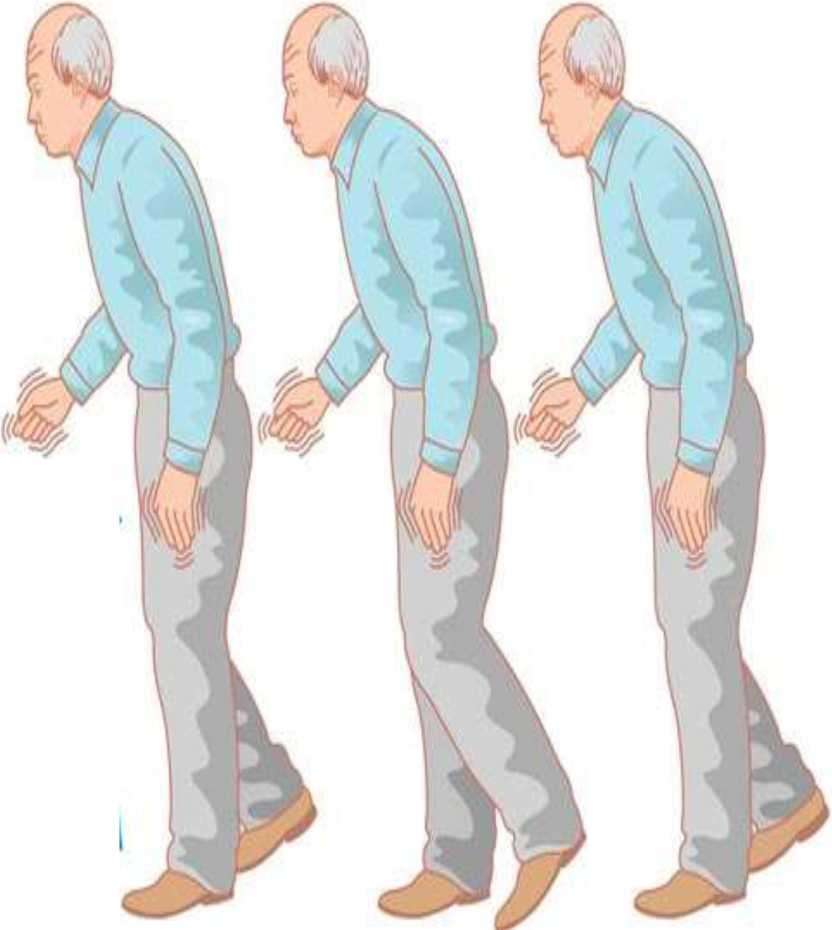 علائم پارکینسون