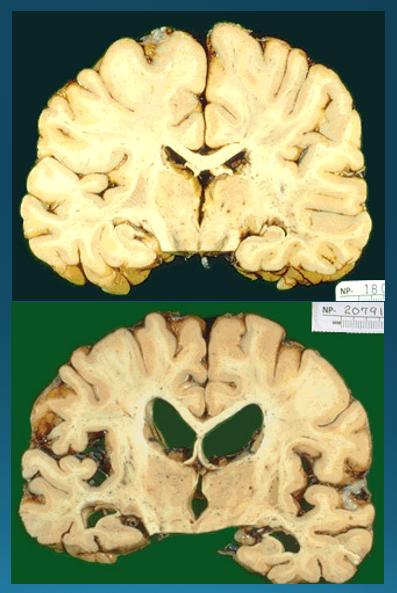 بیماری آلزایمر