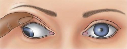 معاینه نورولوژیک عصب زوج سوم مغزی