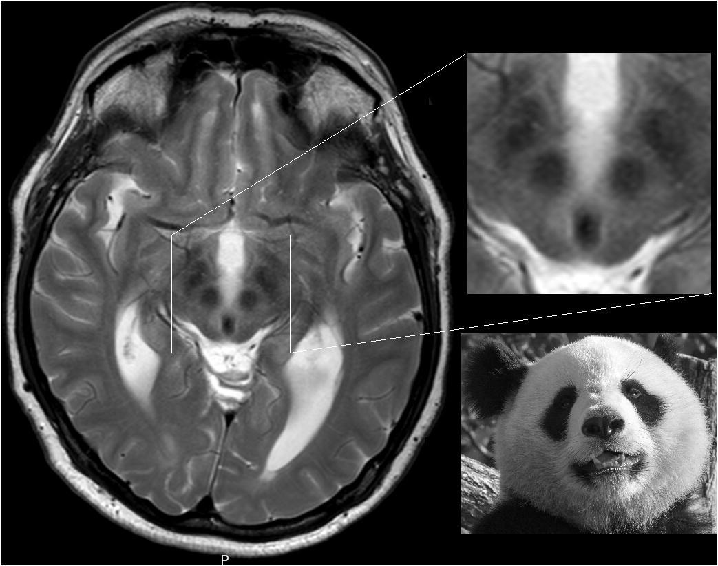 نمای صورت پاندا در MRI بیمار مبتلا به ویلسون