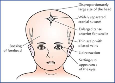 ویژگیهای بالینی هیدروسفالی در نوزادان و کودکان خردسال