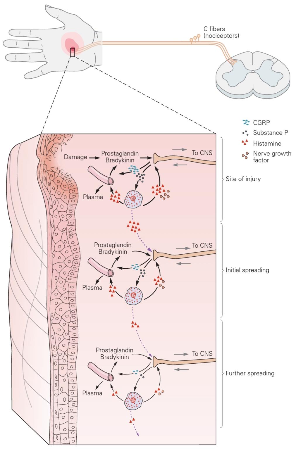 شکل 20-8 التهاب نوروژنیک. آسیب یا صدمه بافتی، برادیکینین و پروستاگلاندینها را آزاد میکند
