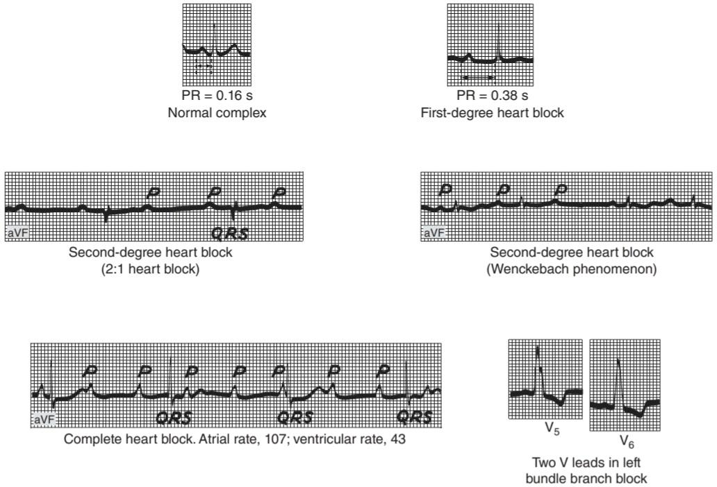 شکل ۲۹.۱۱ ECG با بلوک قلبی. کتاب گانونگ