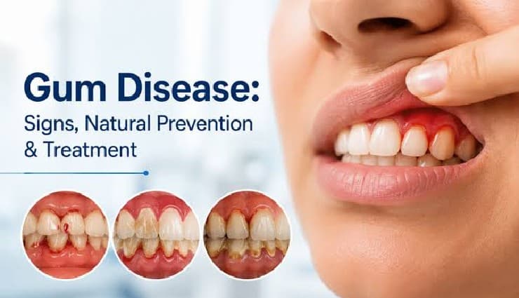 بیماری لثه و دریچه قلب؛ نقش Porphyromonas gingivalis و IL-1β در کلسیفیکاسیون دریچه آئورت