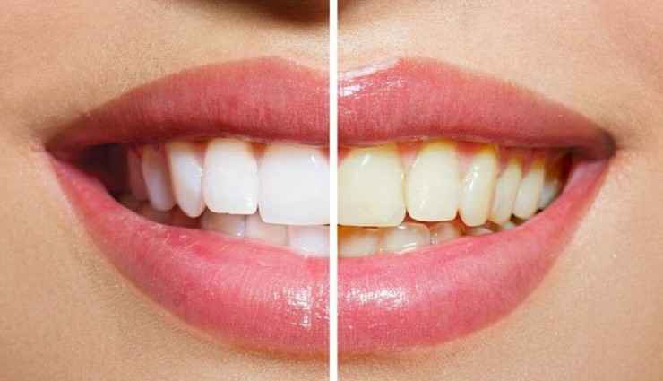 آیا رنگ دندان‌ها به‌طور طبیعی زرد است؟ علت زرد بودن دندان‌ها چیست؟